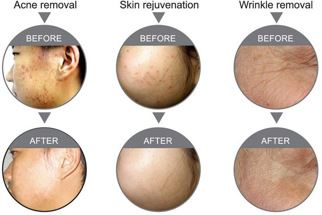 PDT Home Use Led Skin Rejuvenation PDT Beauty Machine For Removing Flecks