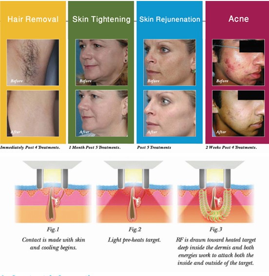 Elight (IPL+RF ) + RF + LASER 3 in 1 Multifunction Skin Rejuvenation, Ipl Hair Removal Machine