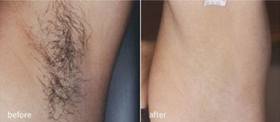 Intense pulsed light (IPL) hair removal clinical study